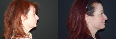 Lower Facelift before and after photo