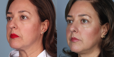 Rhinoplasty before and after photo