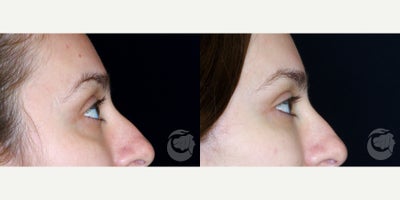 Belotero before and after photo