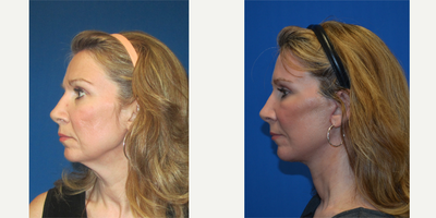 Deep Plane Facelift before and after photo