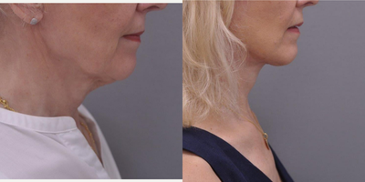 Facelift before and after photo