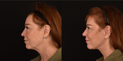 Lower Facelift before and after photo