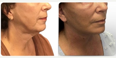 Neck Lift before and after photo