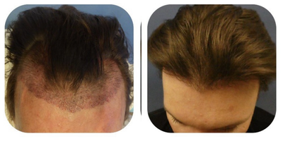 NeoGraft before and after photo