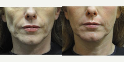 Sculptra before and after photo