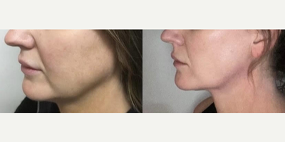 Thread Lift before and after photo