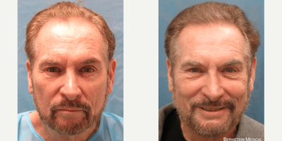 FUE Hair Transplant before and after photo