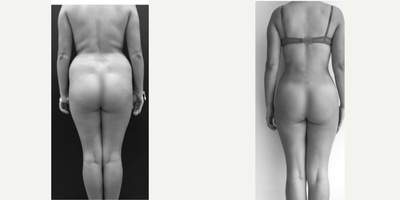 Liposuction before and after photo