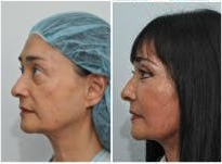 Liquid Facelift before and after photo