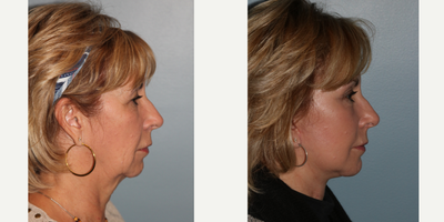 Neck Lift before and after photo