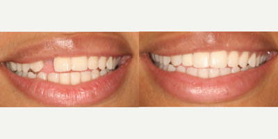 Porcelain Veneers before and after photo