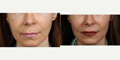 Sculptra before and after photo