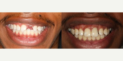 Dental Implants before and after photo