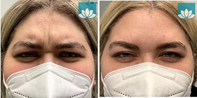 Dysport before and after photo