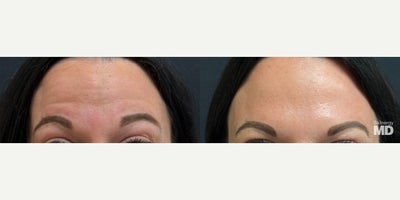 Dysport before and after photo