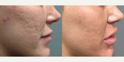 Microneedling before and after photo