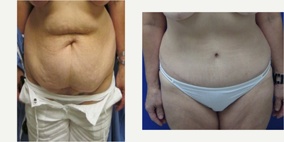 Tummy Tuck before and after photo
