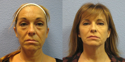 Ultherapy before and after photo