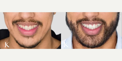 Beard Transplant before and after photo