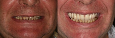 ClearChoice Dental Implants before and after photo