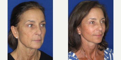 Eyelid Surgery before and after photo