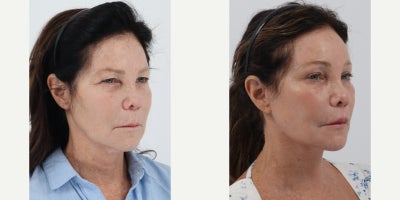 Eyelid Surgery before and after photo