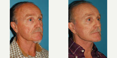 Facelift before and after photo