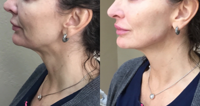 Restylane Lyft before and after photo