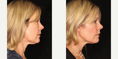 CoolSculpting before and after photo