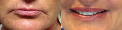 Dermal Fillers before and after photo