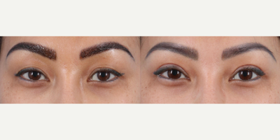 Double Eyelid Surgery before and after photo