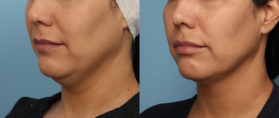 Kybella before and after photo