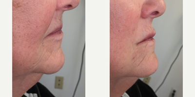 Lip Fillers before and after photo