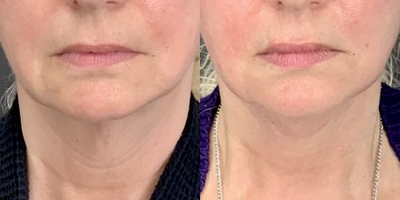 Neck Lift before and after photo