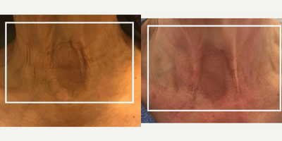 Nonsurgical Neck Lift before and after photo