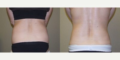 Tumescent Liposuction before and after photo