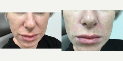 Dermal Fillers before and after photo