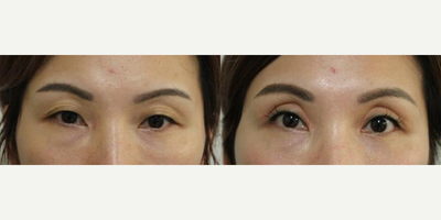 Eyelid Surgery before and after photo