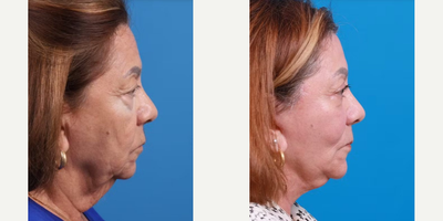 Facelift before and after photo