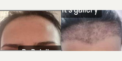 Hair Loss Treatment before and after photo