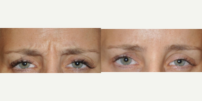 Botox before and after photo