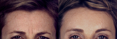 Brow Lift before and after photo