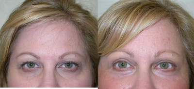 Brow Lift before and after photo