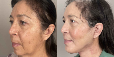 Chin Implant before and after photo