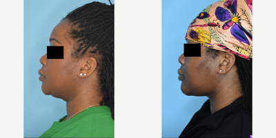 Chin Liposuction before and after photo