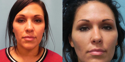 Facial Fat Transfer before and after photo