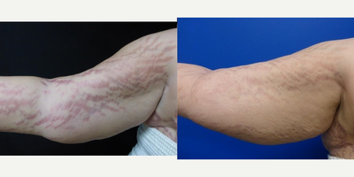 IPL before and after photo
