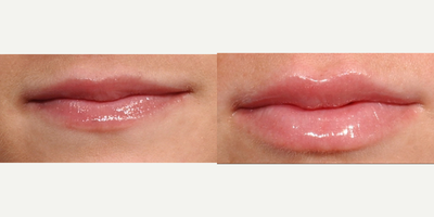 Lip Fillers before and after photo