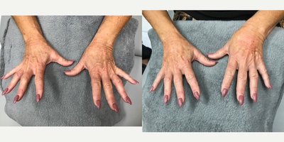 Radiesse before and after photo