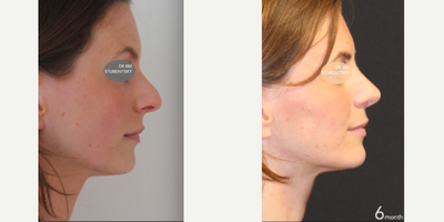 Rhinoplasty before and after photo